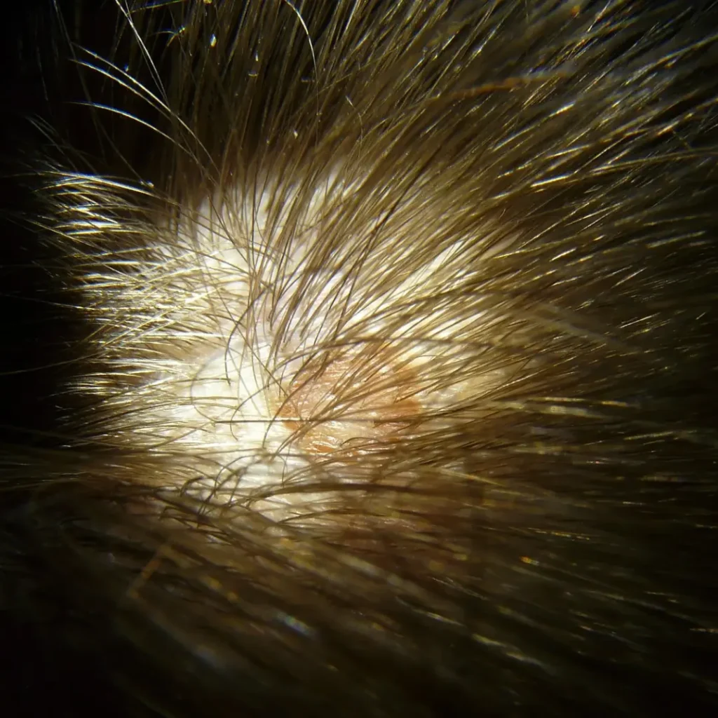 Understanding Scalp Psoriasis