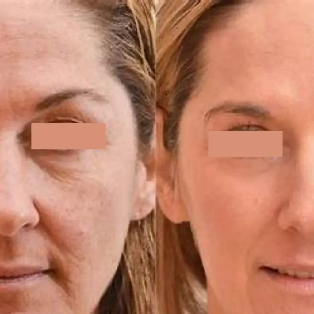 Superjection Facial #1 Houston